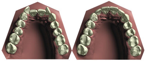 Элайнеры для исправления прикуса
