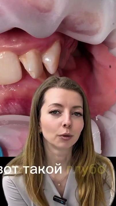 Можно ли вытянуть клык брекетами?