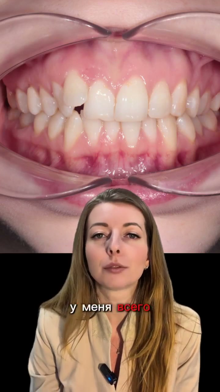 Кривой зуб исправить легко?